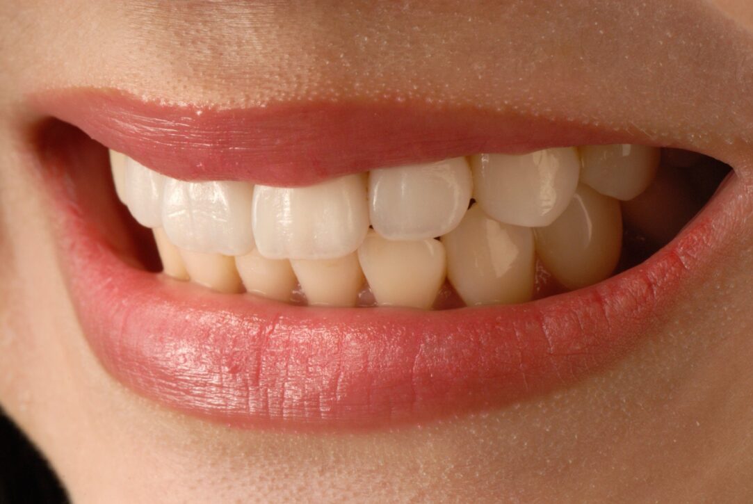 Dental Veneers Process