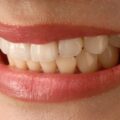 Dental Veneers Process