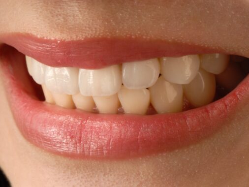 Dental Veneers Process